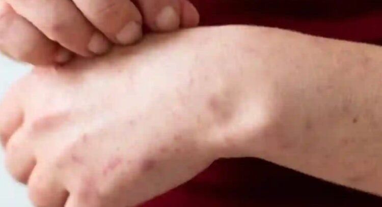 Sigue en aumento el brote de sarampión en México